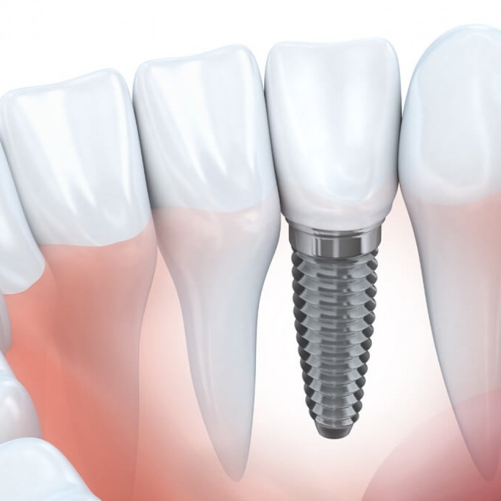 Dental Implants